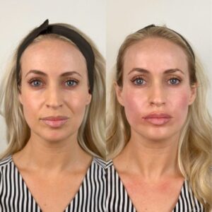 cheek filler before and after