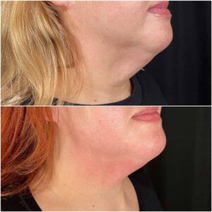 jawline and chin filler before and after