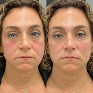 wrinkle filler before and after