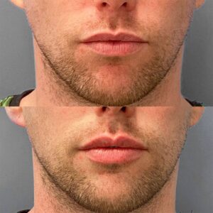 lip filler before and after
